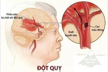 đột quy tai biến là gì 1