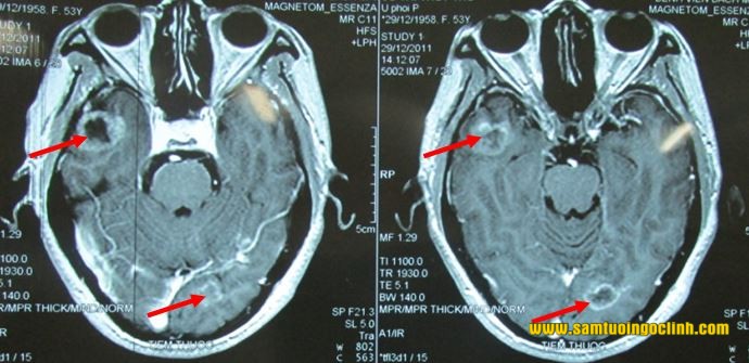 chụp mri sọ não