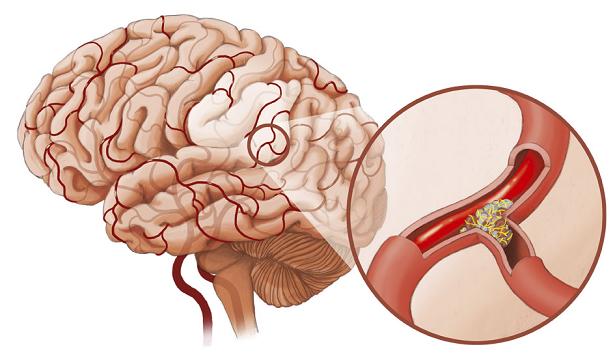 tai biến mạch máu não 1